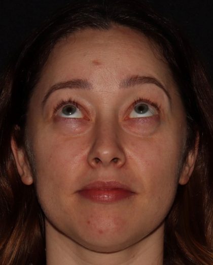Eyelid Surgery Before & After Patient #1354