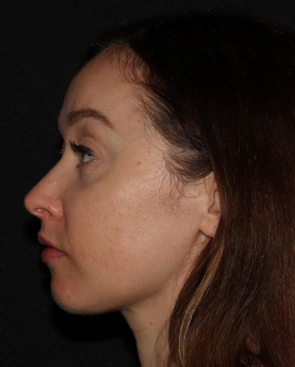 Eyelid Surgery Before & After Patient #1354
