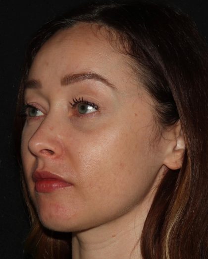 Eyelid Surgery Before & After Patient #1354