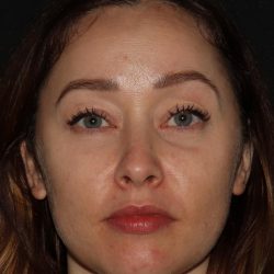 Eyelid Surgery Before & After Patient #1354