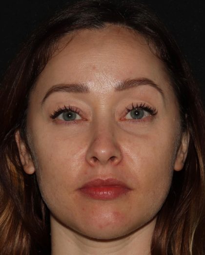 Eyelid Surgery Before & After Patient #1354