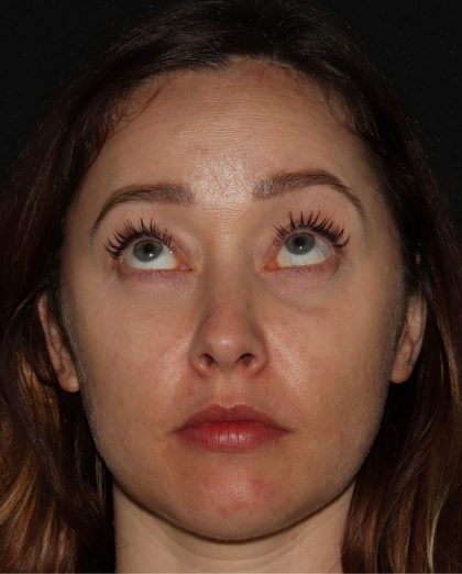 Eyelid Surgery Before & After Patient #1354
