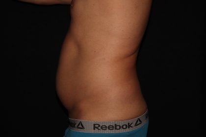 Liposuction Before & After Patient #1338