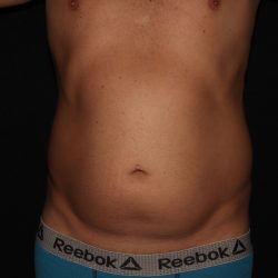 Liposuction Before & After Patient #1338