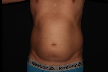 Liposuction Before & After Patient #1338