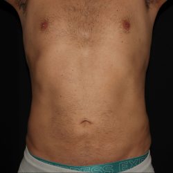 Liposuction Before & After Patient #1338