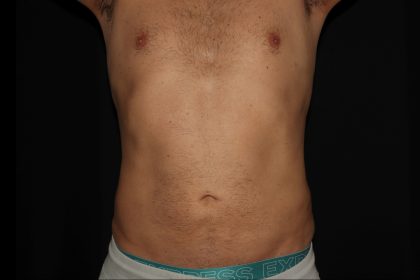 Liposuction Before & After Patient #1338