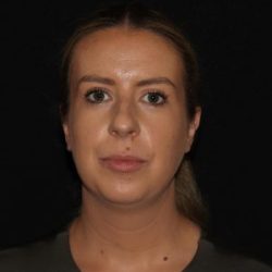 Facial Contouring Before & After Patient #1265