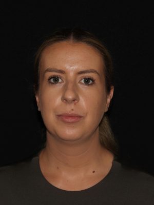 Facial Contouring Before & After Patient #1265