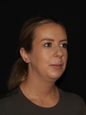 Facial Contouring Before & After Patient #1265
