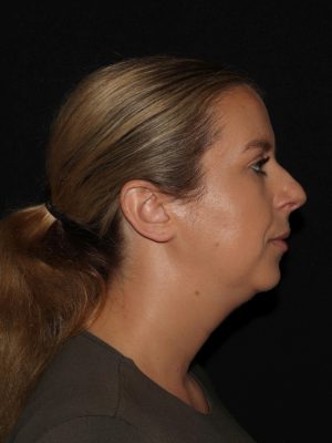 Facial Contouring Before & After Patient #1265