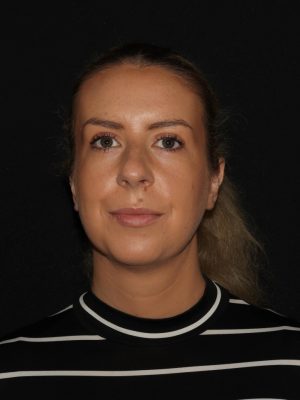 Facial Contouring Before & After Patient #1265
