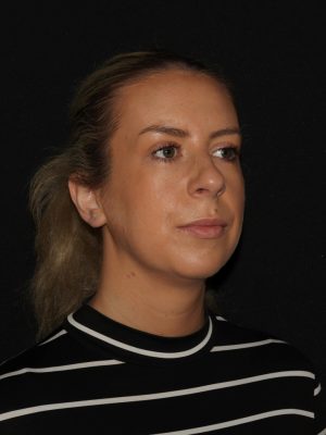 Facial Contouring Before & After Patient #1265