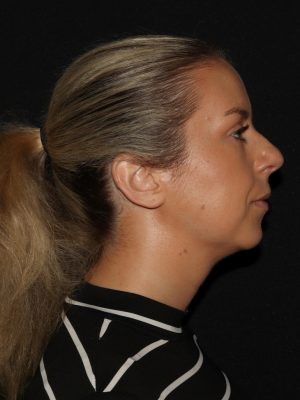 Facial Contouring Before & After Patient #1265