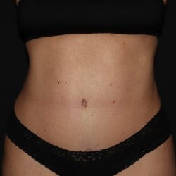Tummy Tuck Before & After Patient #1324