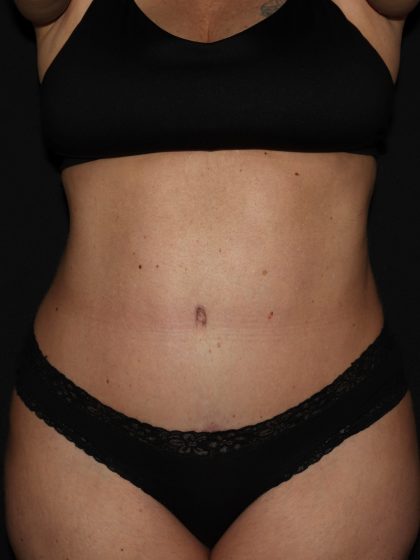 Tummy Tuck Before & After Patient #1324
