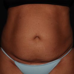 Tummy Tuck Before & After Patient #1324