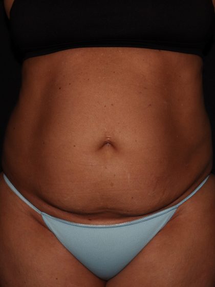 Tummy Tuck Before & After Patient #1324