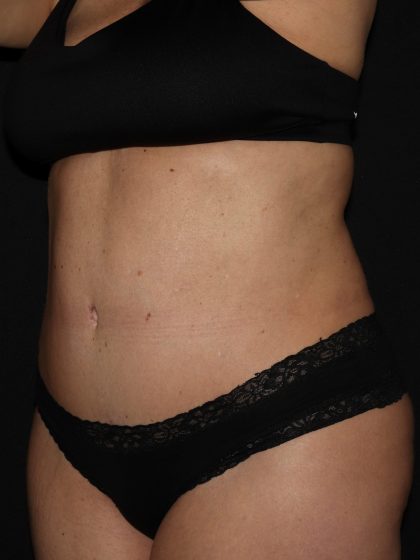 Tummy Tuck Before & After Patient #1324
