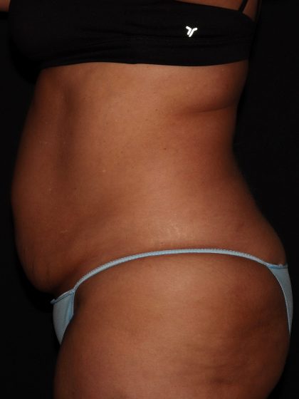 Tummy Tuck Before & After Patient #1324