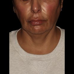 Deep Plane Facelift & Necklift Before & After Patient #1551