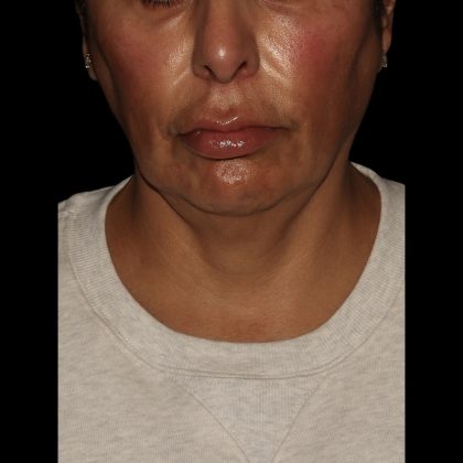 Deep Plane Facelift & Necklift Before & After Patient #1551