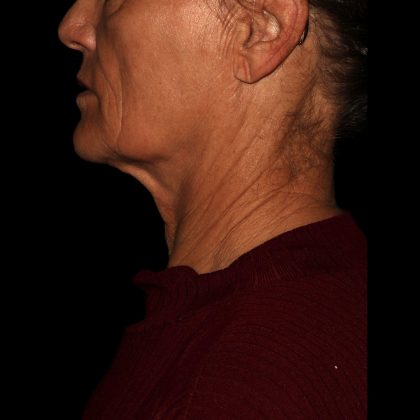 Deep Plane Facelift & Necklift Before & After Patient #1552