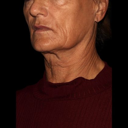 Deep Plane Facelift & Necklift Before & After Patient #1552