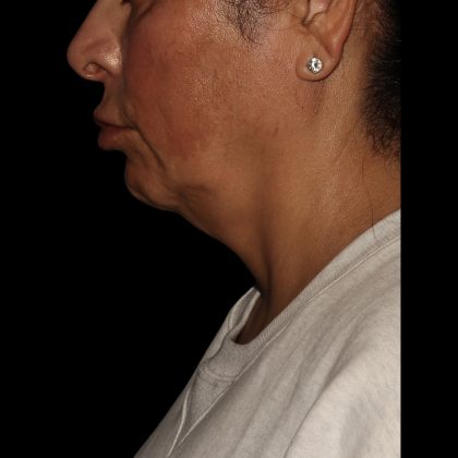 Deep Plane Facelift & Necklift Before & After Patient #1551