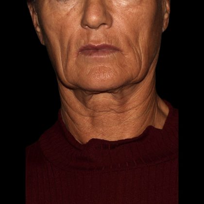 Deep Plane Facelift & Necklift Before & After Patient #1552
