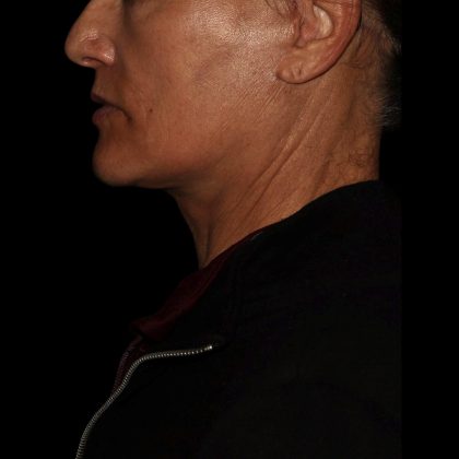 Deep Plane Facelift & Necklift Before & After Patient #1552