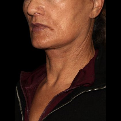 Deep Plane Facelift & Necklift Before & After Patient #1552