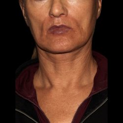 Deep Plane Facelift & Necklift Before & After Patient #1552