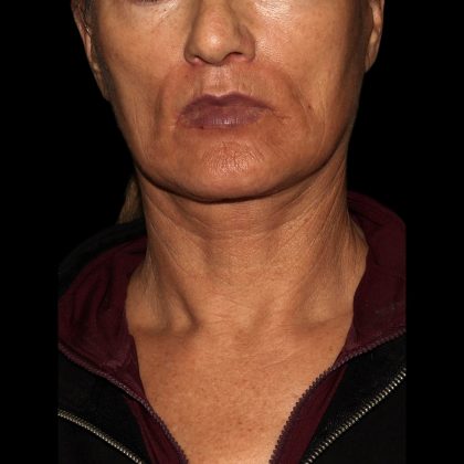 Deep Plane Facelift & Necklift Before & After Patient #1552