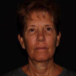 Deep Plane Facelift & Necklift Before & After Patient #1603