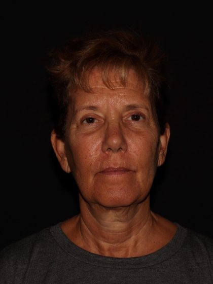 Deep Plane Facelift & Necklift Before & After Patient #1603