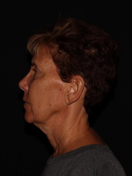 Deep Plane Facelift & Necklift Before & After Patient #1603