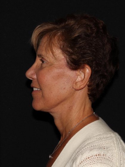 Deep Plane Facelift & Necklift Before & After Patient #1603