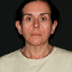 Deep Plane Facelift & Necklift Before & After Patient #1610