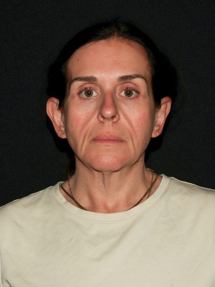 Deep Plane Facelift & Necklift Before & After Patient #1610