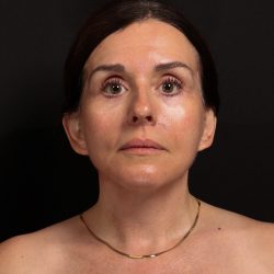 Deep Plane Facelift & Necklift Before & After Patient #1610