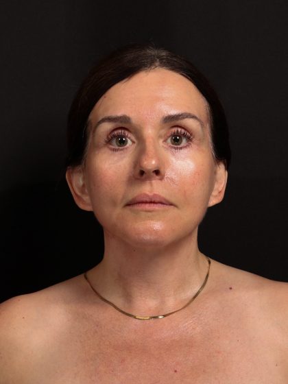 Deep Plane Facelift & Necklift Before & After Patient #1610