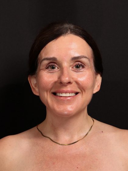 Deep Plane Facelift & Necklift Before & After Patient #1610