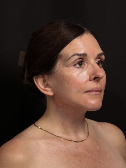 Deep Plane Facelift & Necklift Before & After Patient #1610