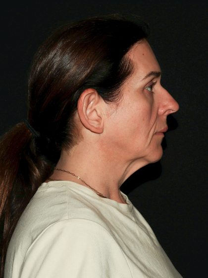 Deep Plane Facelift & Necklift Before & After Patient #1610