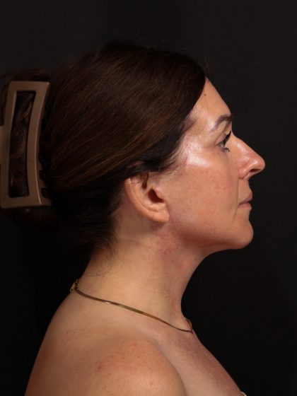 Deep Plane Facelift & Necklift Before & After Patient #1610